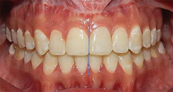 Fig. 13 Intraoral frente