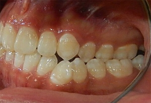 Fig. 2 Intraoral izquierda