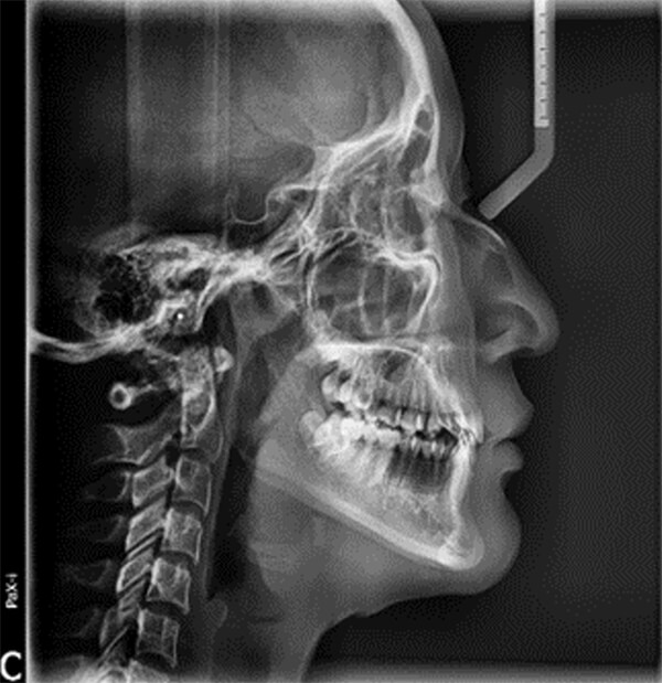 Fig. 6 Radiografía lateral de inicio