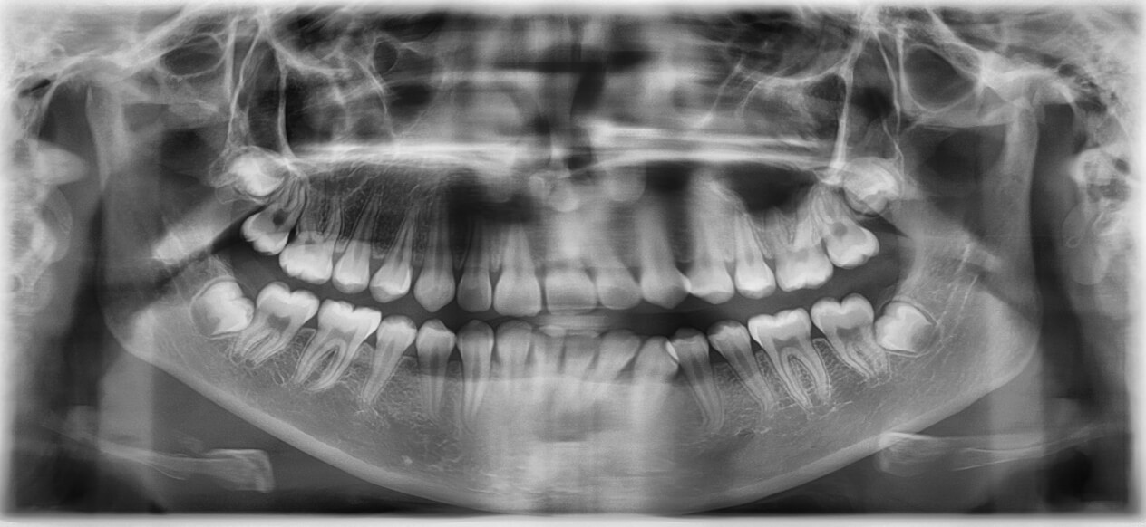 Fig. 7 Radiografía Panorámica