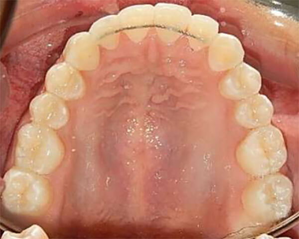 Fig. 8 Oclusal superior final