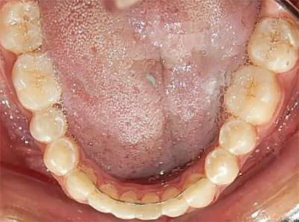 Fig. 9 Oclusal inferior final