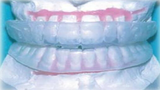 Figura 1: Retenedor posicionador invisible de Ponitz, sobre un set-up o montaje encerado, para hacer pequeños movimientos dentarios, tomado de “Revisión histórica de la técnica invisalign”