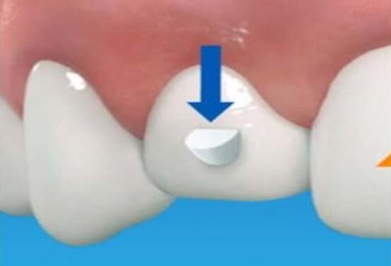 Figura 4: Ataches biselados, “Alineadores Invisibles” tomado de la “Revisión histórica de la técnica invisalign”