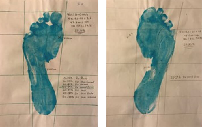 Figura 4. Evaluación de las huellas plantares.