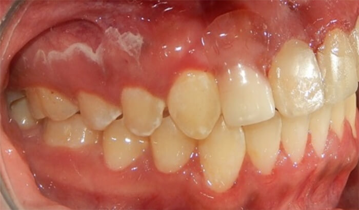 Fig 13. Lateral derecha