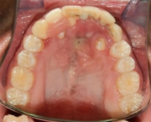 Fig. 14. Oclusal superior final