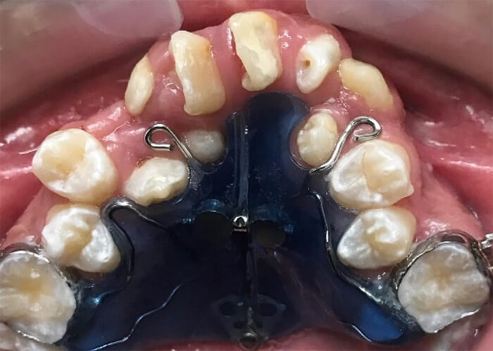 Fig 8.Vista oclusal superior