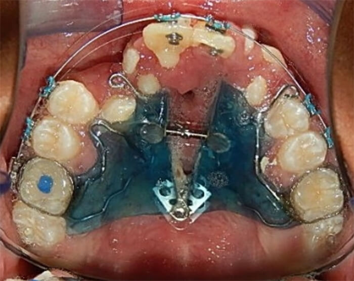 Fig 9 Vista oclusal superior