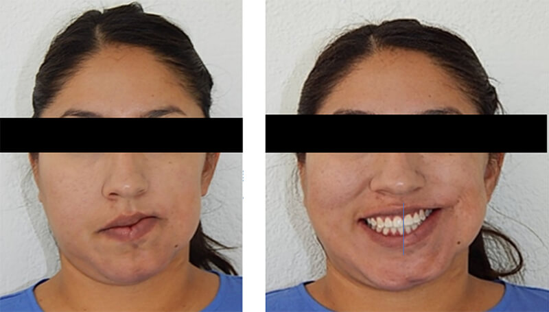 Fig 8. Final extraoral  de frente, sonrisa