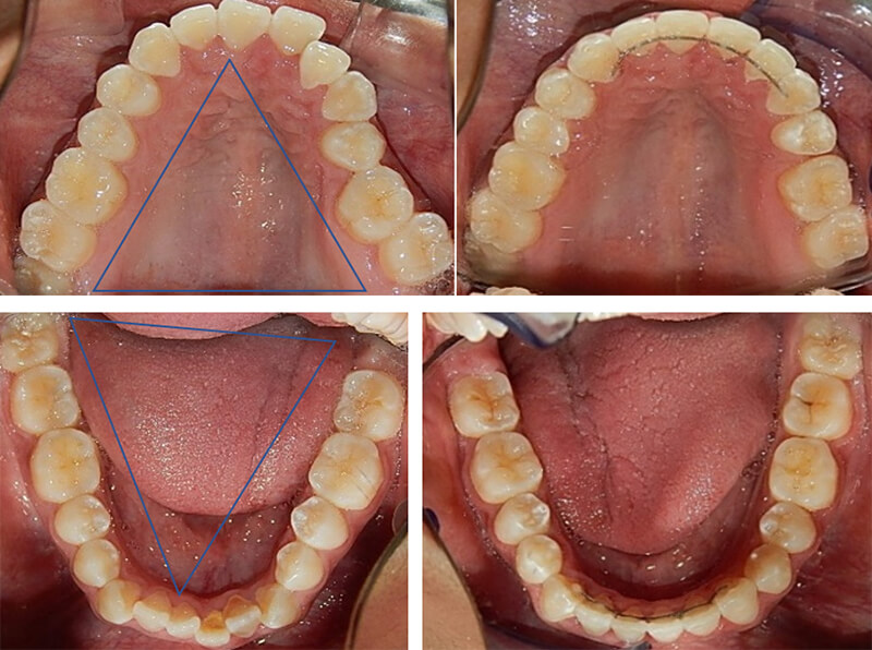 Fig 9. Vista oclusal comparación inicio- final superior e inferior