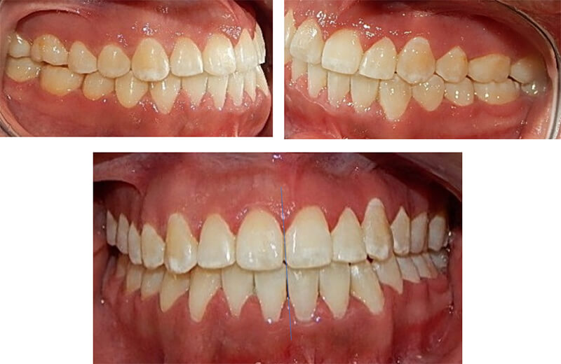 Fig 10. Fotografía intraoral final derecha, izquierda y de frente