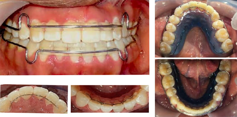 Fig 11. Vista oclusal retenedores fijos y circunferenciales