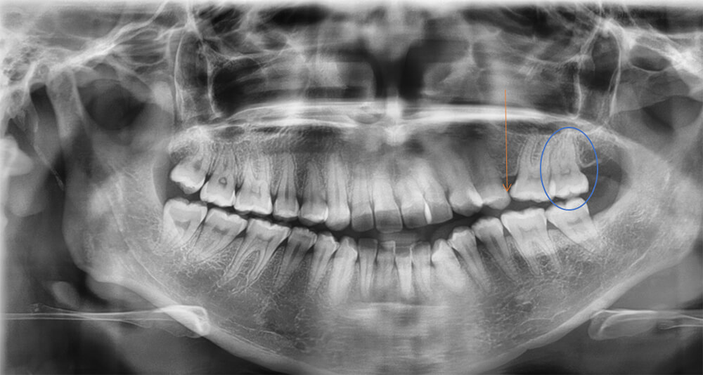 Fig 3. Radiografía  Panorámica inicio