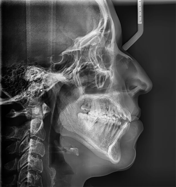 Fig 4 Radiografía cefálica lateral inicio