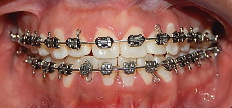 Fig 5.  Intraoral de frente de control