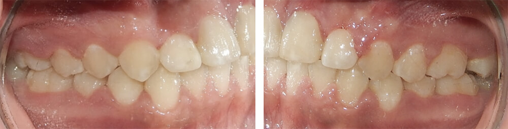 Fig. 11 Final intraoral derecha e izquierda