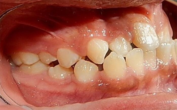 Fig. 4 derecha