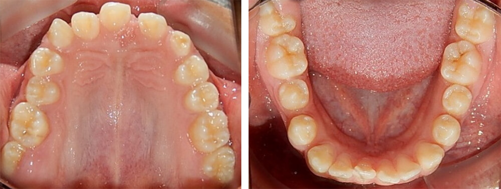 Fig. 6 Vista oclusal superior e inferior