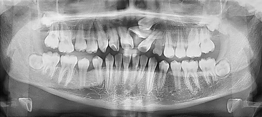 Fig. 7 Rx Panorámica