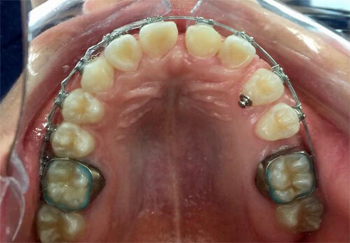 Fig. 9 oclusal canino en posición del incisivo central