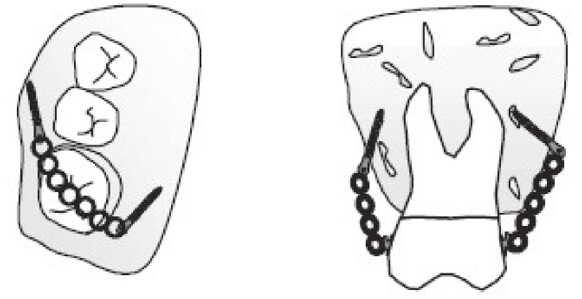 Figura 2 Intrusión de molares