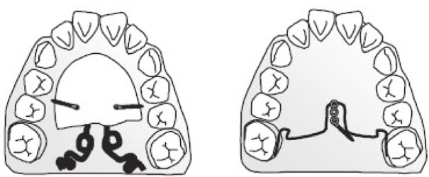 Figura 3 Distalización de molares