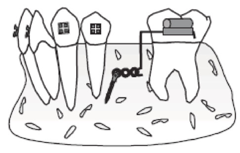 Figura 4 Mesialización de molares