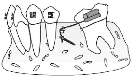 Figura 6 Verticalización de molares