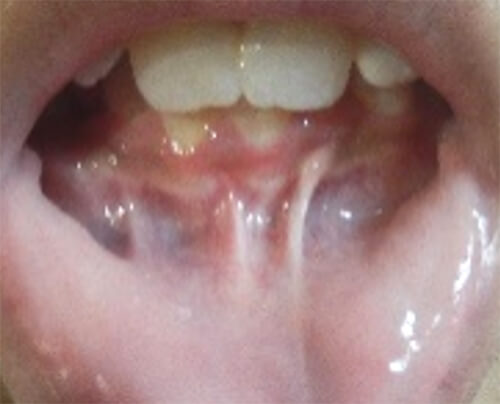 Figura 1. Examen intraoral de la región del frenillo labial inferior