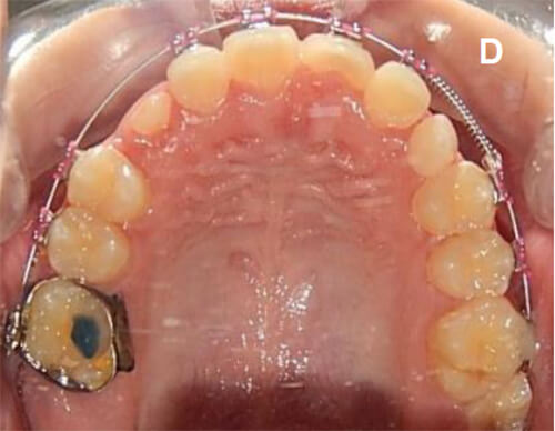 Fig. 10 D Vista oclusal forma oval de los arcos