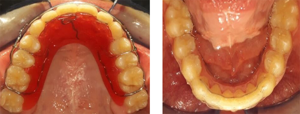 Fig 11 A. Circunferencial con finger superior.