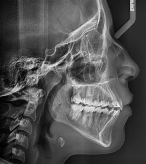 Fig 12. Radiografia lateral final