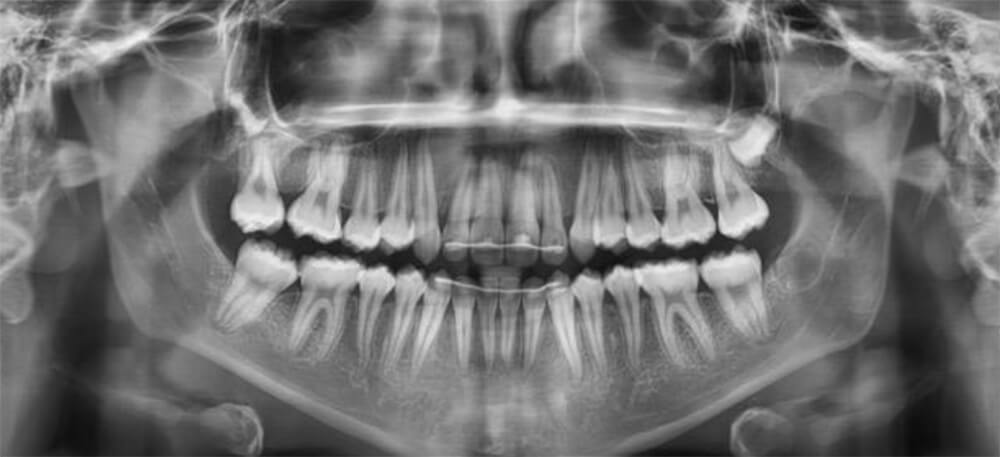 Fig 13. Radiografia panoramica final