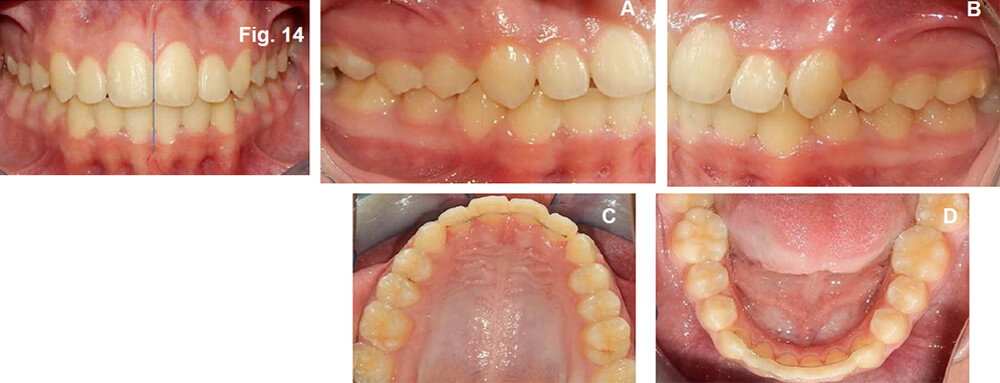 Fig. 14 líneas medias coincidentes, A y B laterales Relación Molar y canina clase I, con overbite mejorado, 14 C y D vista Oclusal superior e inferior