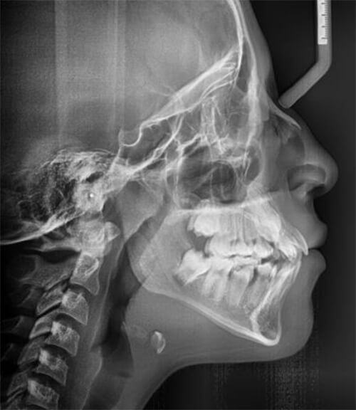 Fig. 4 Radiografía lateral, crecimiento hiperdivergente, proclinación de incisivos.