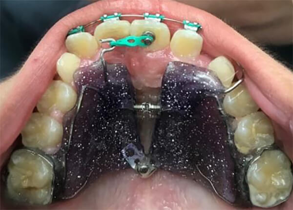 Fig. 9 Hass superior modificado