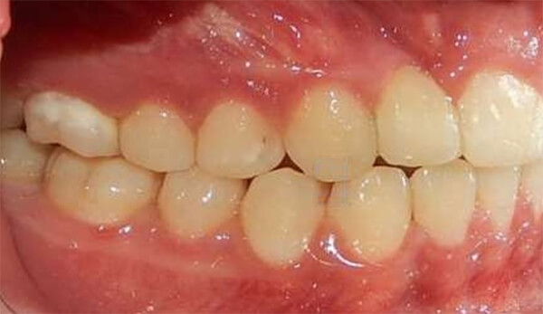 Fig. 11 Intraoral derecha