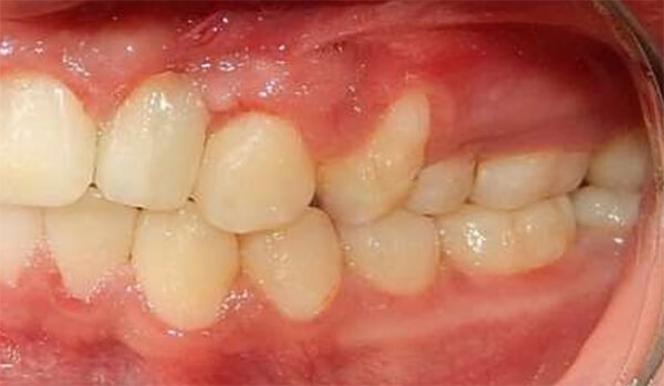 Fig. 12 Intraoral Izquierda