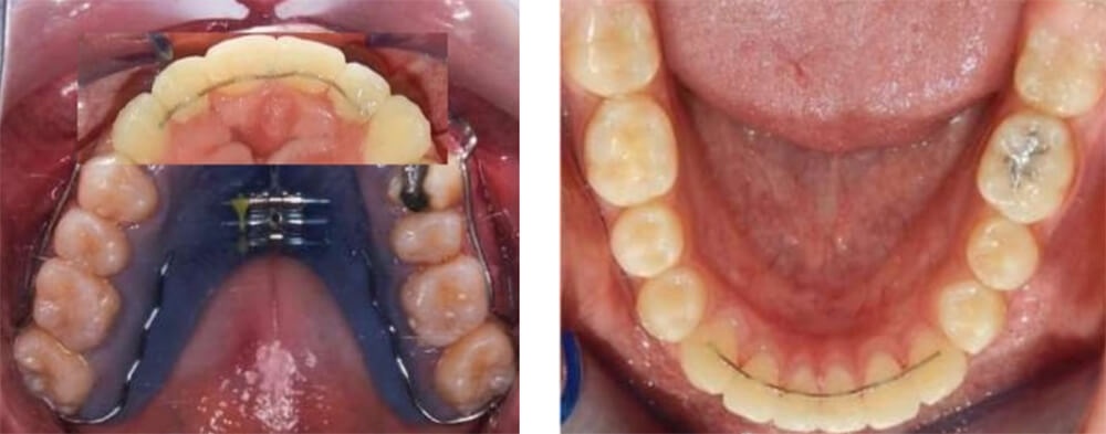 Fig. 14 Oclusal superior e inferior