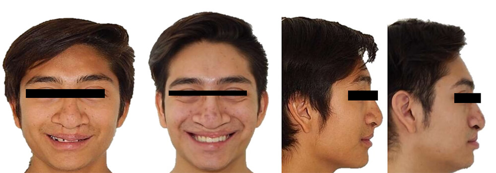 Fig. 16 comparativo inicio  final; sonrisa perfil