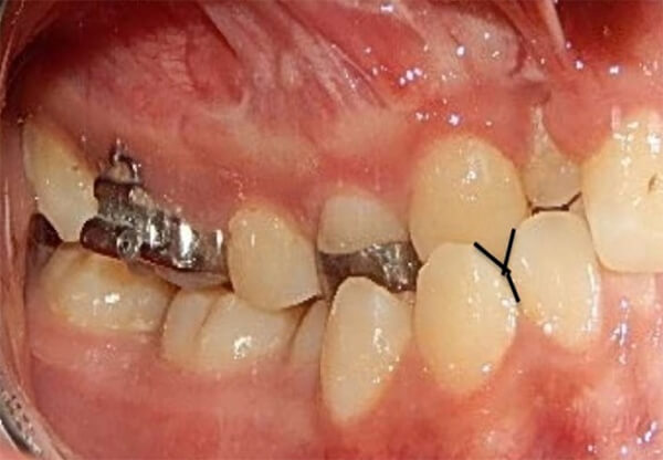 Fig. 3 Intraoral derecha