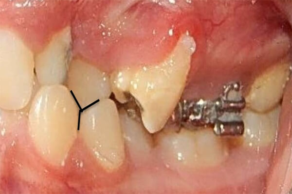 Fig. 5 Intraoral Izquierda