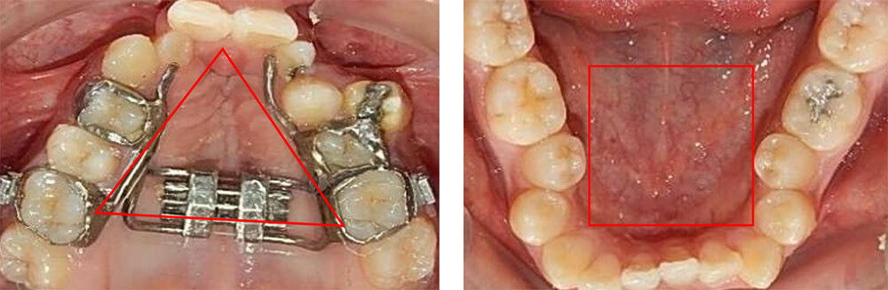 Fig. 6  oclusal superior e inferior