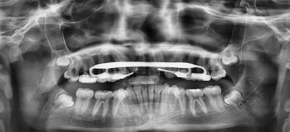 Fig. 7 Radiografía Panorámica