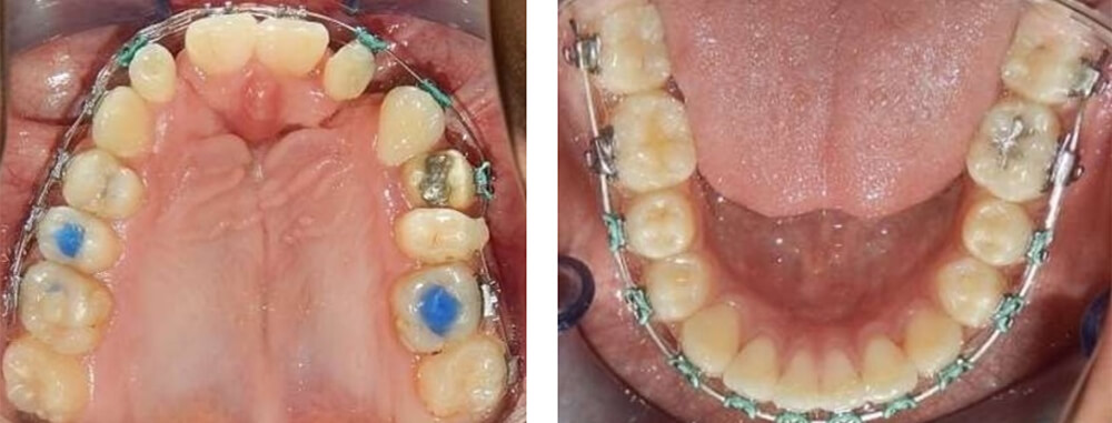 Fig. 9 Oclusal superior e inferior