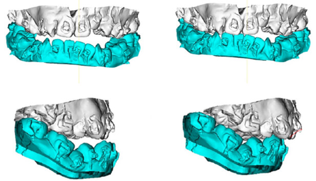Figura 2.- Arcos dentales antes (izquierda) y después (derecha) de la movilización quirúrgica para alcanzar la oclusión con la que iniciara el tratamiento de Ortodoncia