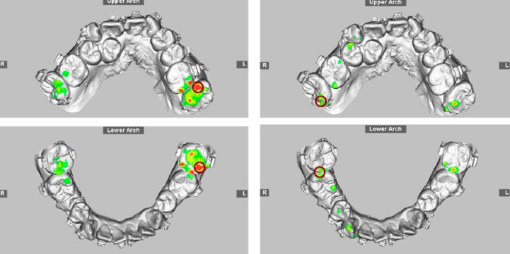 Figura 3.-Oclusograma con mapa de color 3D que muestra la reducción del contacto dental en región posterior (color rojo y verde) debido a la creación de contacto anterior (color verde), este es un paso importante adoptado para la configuración de la oclusión quirúrgica en el abordaje de cirugía primero.