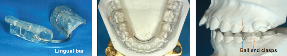 Figura 7. Modelos quirúrgicos mostrando retroceso mandibular y férula quirúrgica