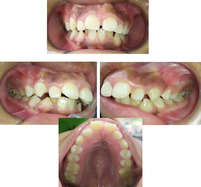 ANEXO D [Ejemplo de Fotografías Realizadas a los Pacientes: Frontal, Laterales y Oclusal Superior]